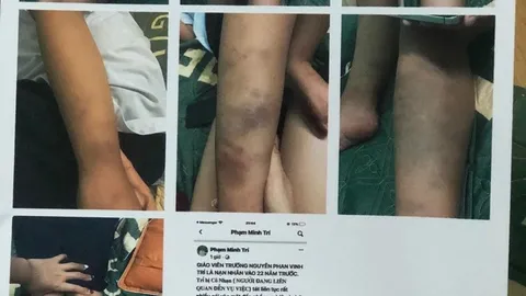 Vụ học sinh lớp 1 bị đánh bầm tím: Tiết lộ lời kể của cháu bé với mẹ?