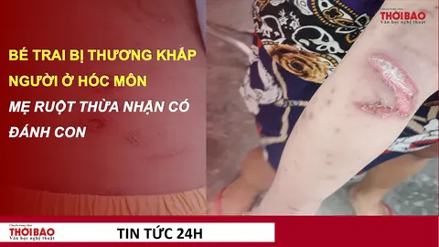 Vụ bé trai 2 tuổi nhập viện ở Hóc Môn: Mẹ ruột thừa nhận có đánh con