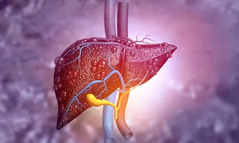 Không béo vẫn có thể mắc gan nhiễm mỡ: 5 thói quen nên thay đổi càng sớm càng tốt, số 3 nhiều người tưởng tốt cho sức khỏe