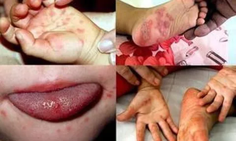 6 điều rất nhiều người đang hiểu sai về bệnh tay chân miệng