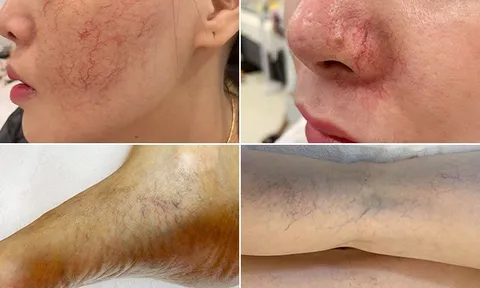 Kinh nghiệm phục hồi da giãn mao mạch từ chuyên gia da liễu đầu ngành 