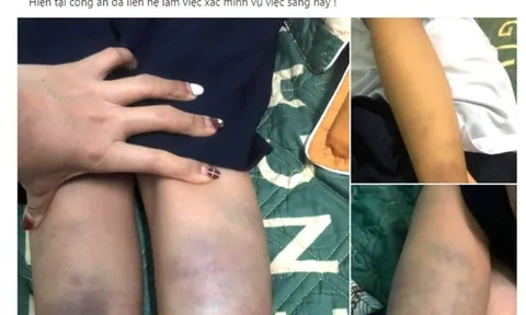 Thông tin mới nhất vụ học sinh lớp 1 bị bạn đánh bầm tím trên lớp