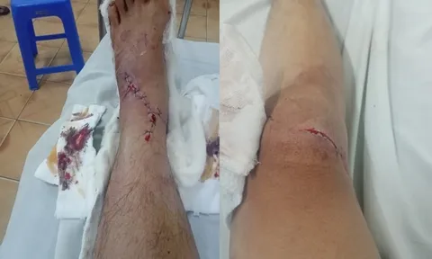 Thông tin mới vụ nam thanh niên bị truy sát nghi ghen tuông