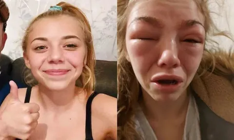 Cô bé 14 tuổi suýt mất mạng vì ham nhuộm lông mày, nối mi