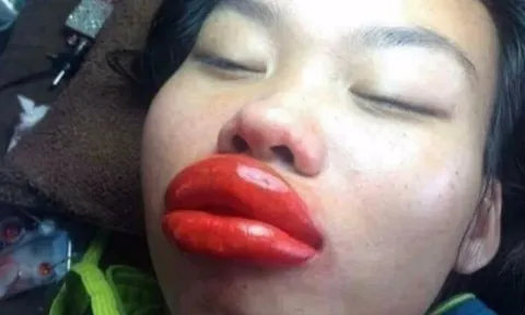 'Độ' môi xinh đón Tết, cô gái nhận về cái kết đắng, sưng tấy như ong chích