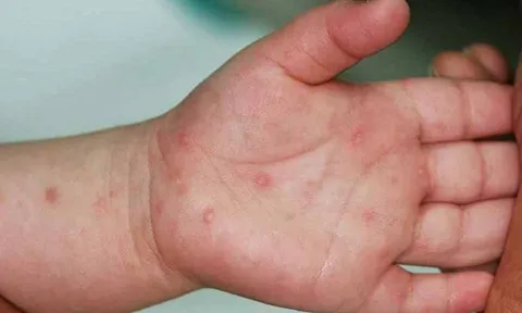 Hà Nội: Số ca tay chân miệng tăng gấp 4, đặc biệt chú ý 3 dấu hiệu này