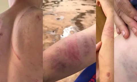 Khởi tố cha ruột và bà nội đánh cháu bé 9 tuổi thương tích đầy người