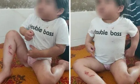 Nghi bé 4 tuổi bị bạo hành, bác sĩ báo công an vào cuộc điều tra