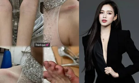 Đỗ Thị Hà lộ loạt dấu hiệu cơ thể bất ổn với nhiều vết trầy trên người