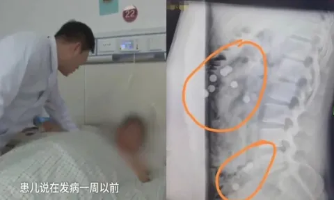 Chuyện lạ: Chàng trai đau thắt lưng, đi chụp X-quang phát hiện một bụng toàn trân châu