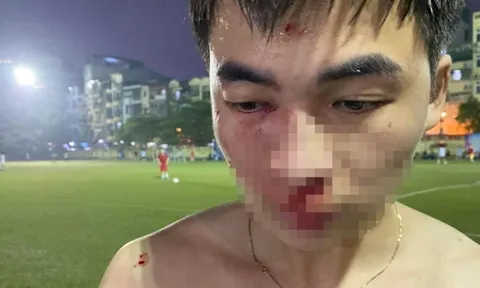 Nam thanh niên tố bị đánh gãy mũi trên sân phủi ở Hà Nội