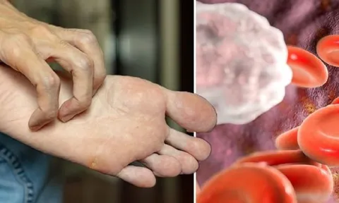 Xuất hiện 4 bệnh ngoài da này đi làm xét nghiệm máu ngay, cẩn thận tim mạch đang cầu cứu