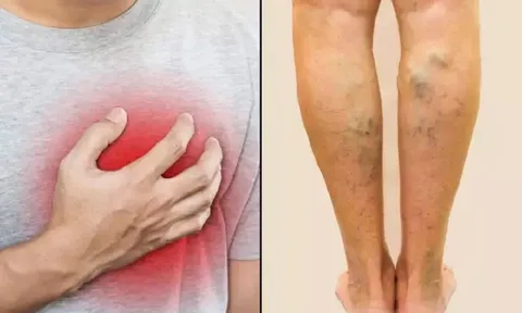 Chân sưng phù đột ngột không rõ nguyên nhân, đi khám ngay trước khi căn bệnh thầm lặng này chuyển biến nặng