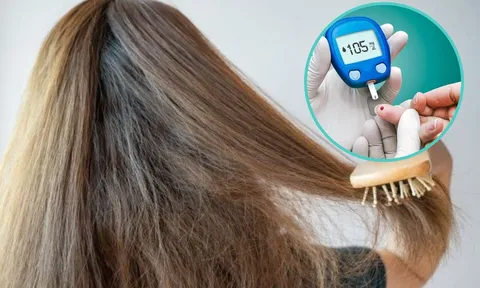 Triệu chứng thầm lặng của bệnh tiểu đường mà bạn có thể phát hiện khi chải đầu