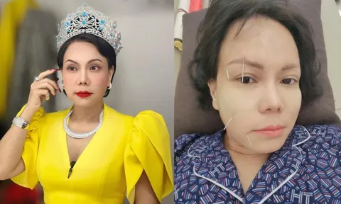 Việt Hương bị méo 1 bên mặt phải châm cứu điều trị, nguyên nhân khiến dân tình xót xa