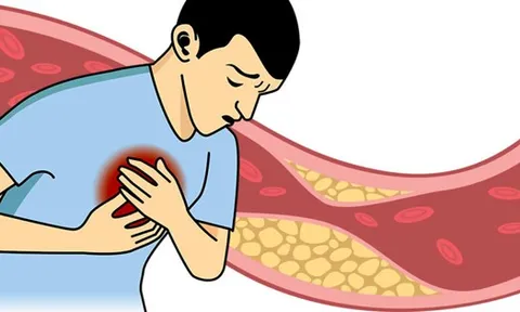 Nattokinase Jintan Nhật Bản – giải pháp mới cho người mỡ máu cao, phòng bệnh tai biến và tim mạch