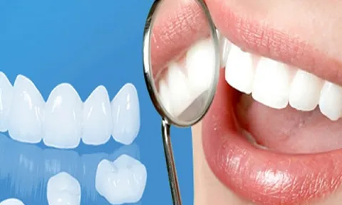 Bọc răng sứ thẩm mỹ là gì? Chi phí bao nhiêu và đâu là địa chỉ uy tín