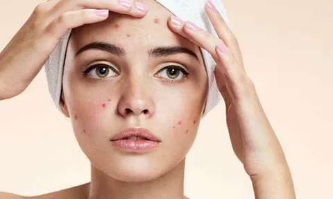 Hướng dẫn chăm sóc da đúng cách sau khi nặn mụn