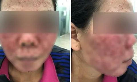 Hiểm họa khôn lường từ việc làm trắng da mặt bằng hóa chất trôi nổi