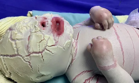 Bé sơ sinh mắc bệnh hiếm, da toàn thân bọc vảy trắng và nhiều vết nứt