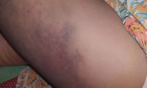 Vụ cô giáo đánh tím đùi bé gái lớp 3 vì "làm bài sơ sài": Cơ quan chức năng nói gì?