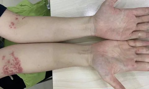 Hy hữu một phụ nữ 32 tuổi mắc bệnh tay chân miệng